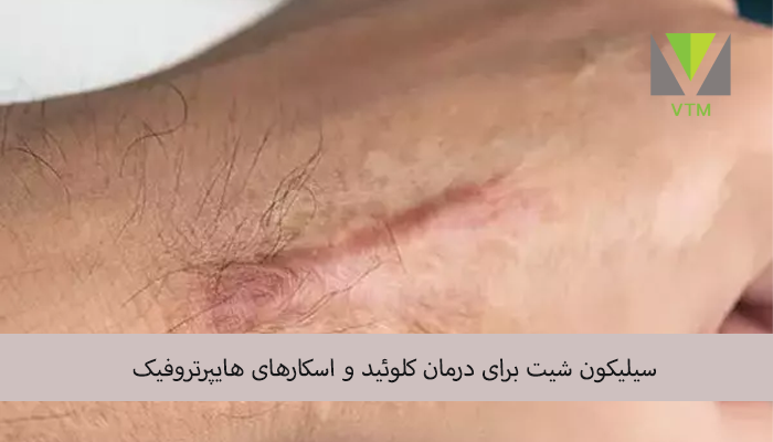 سیلیکون شیت برای درمان کلوئید و اسکارهای هایپرتروفیک