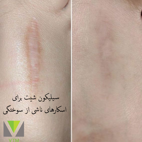 اسکارهای ناشی از سوختگی