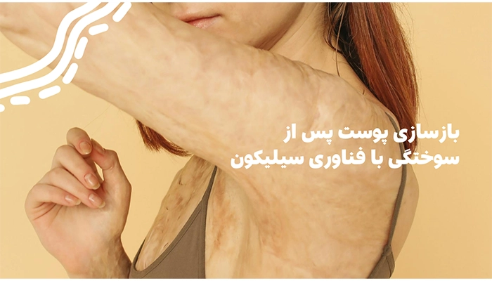 میزان اثرگذاری سیلیکون شیت در سوختگی