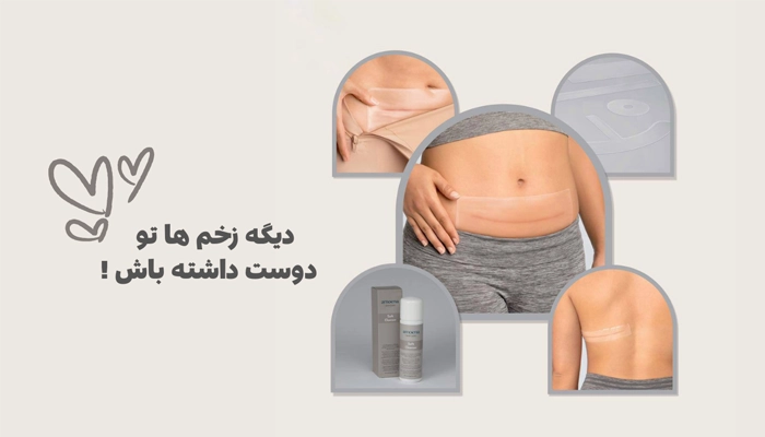 نحوه استفاده از سیلیکون شیت برای جای سوختگی